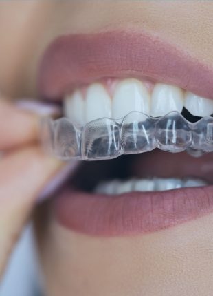 aligner
